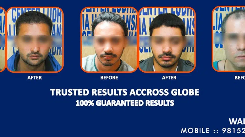 Walia Hair Transplant