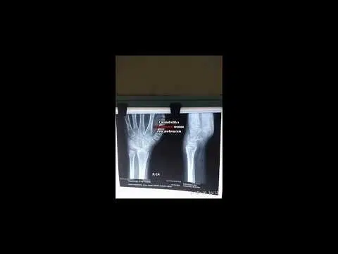 Permanent relief of pain