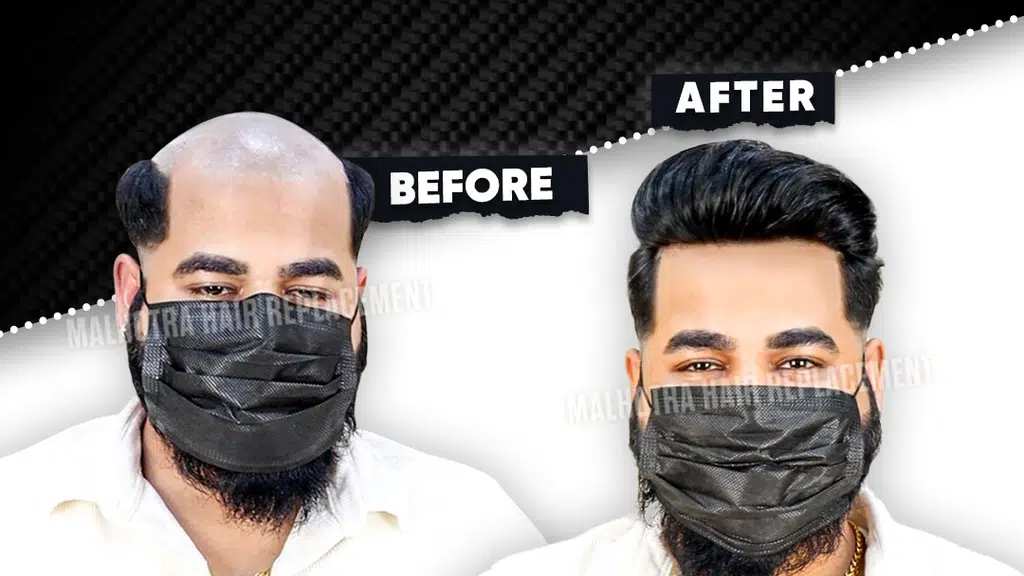 Malhotra Hair Replacement