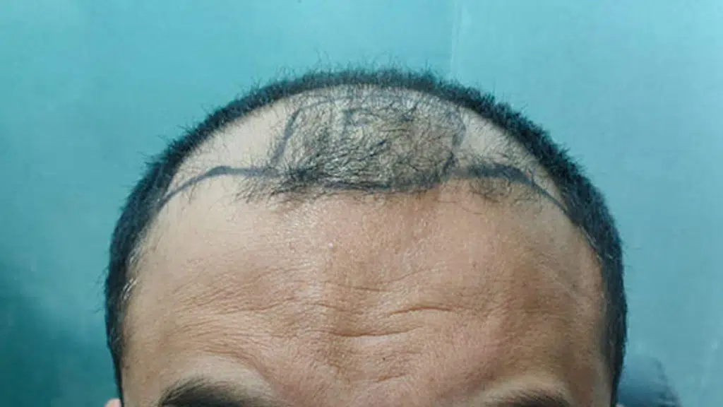 Hairich Hair Clinic ! Best Hair Transplant Clinic! Best Hair Patch Clinic in Delhi