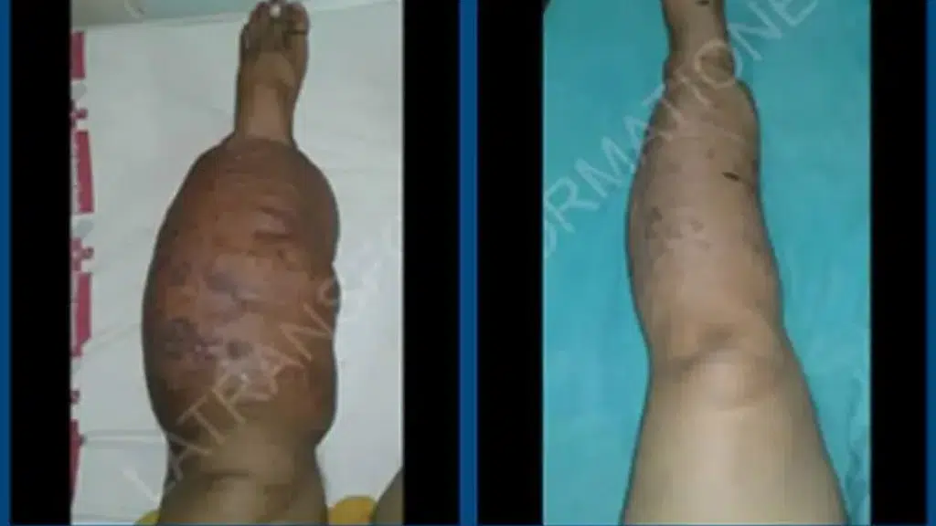 Mumbai Lymphedema Center