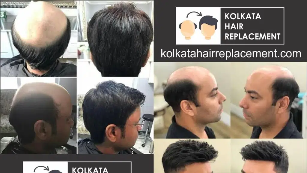 Kolkata Hair Replacement