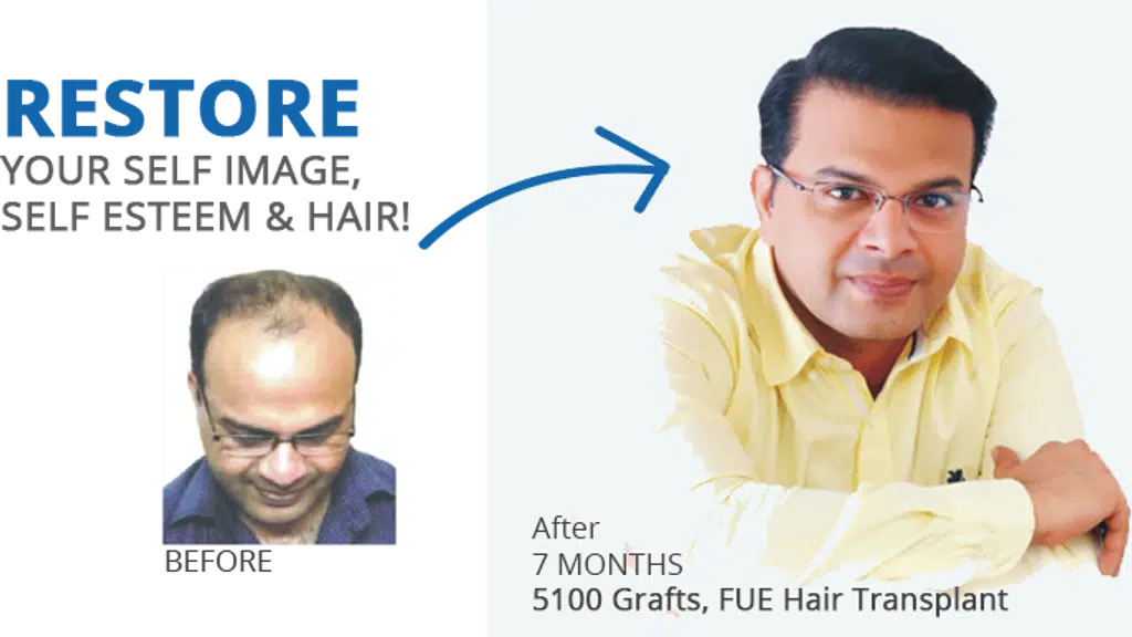 Athena Hair Now Hair Transplant
