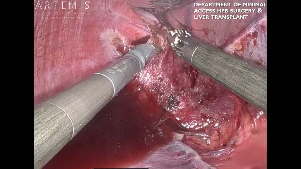 Dr. Shyam Sunder Mahansaria : Leading Liver Transplantation & HPB Surgeon in India