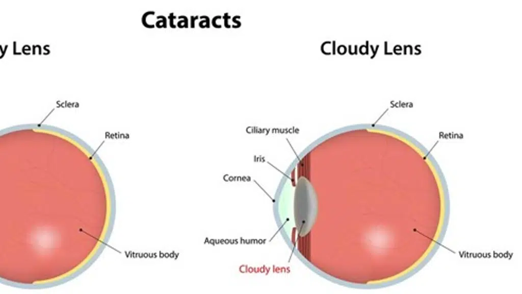 DR Sachin ARYA , cataract cornea refractive eye surgeon