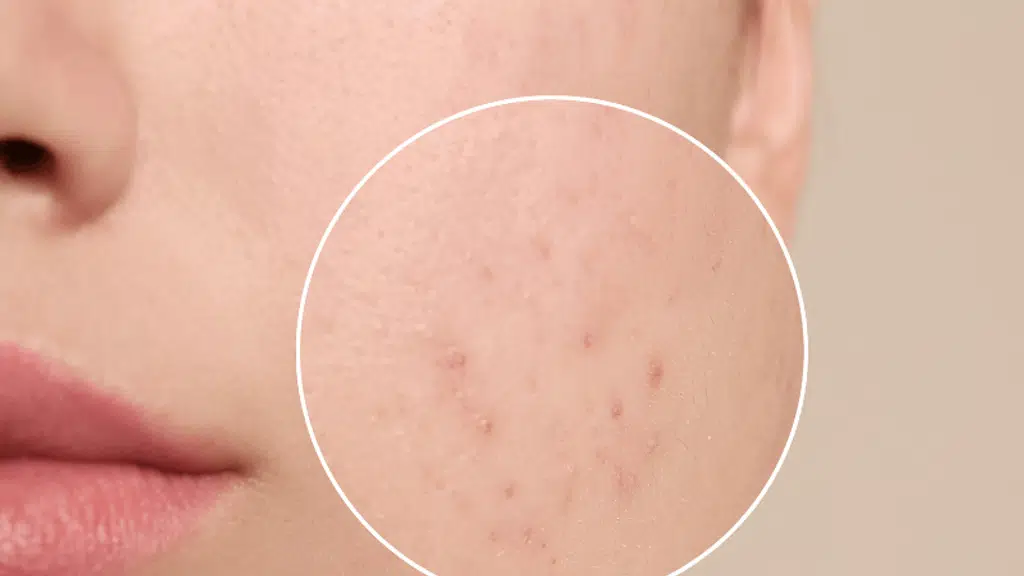 The Derma Theory