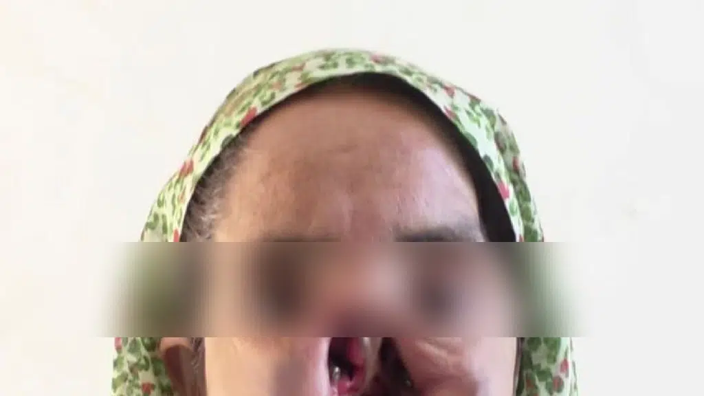 ENHANCE Head Neck Rehabilitation