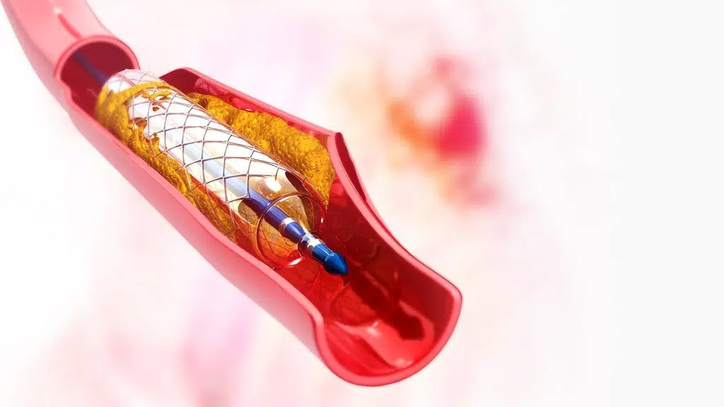 Vascular expert