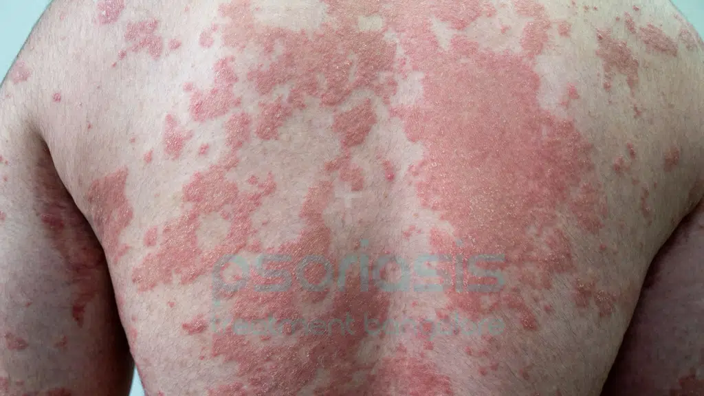 Best Psoriasis Treatment in Bangalore (ಸೋರಿಯಾಸಿಸ್ ಚಿಕಿತ್ಸಾ ಕೇಂದ್ರ)