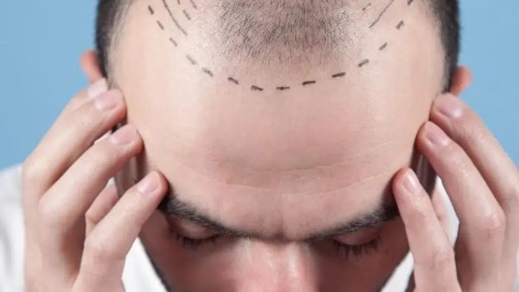 Derma Clinique : Advanced Centre for Hair Transplant & Skin diseases