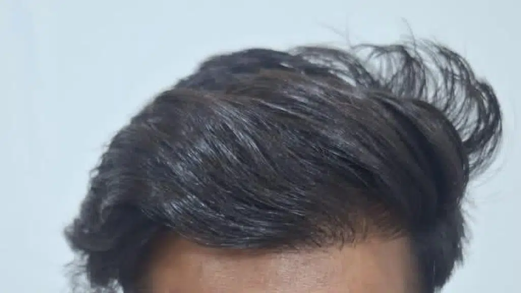 Hair Roots Hair Transplant Centre
