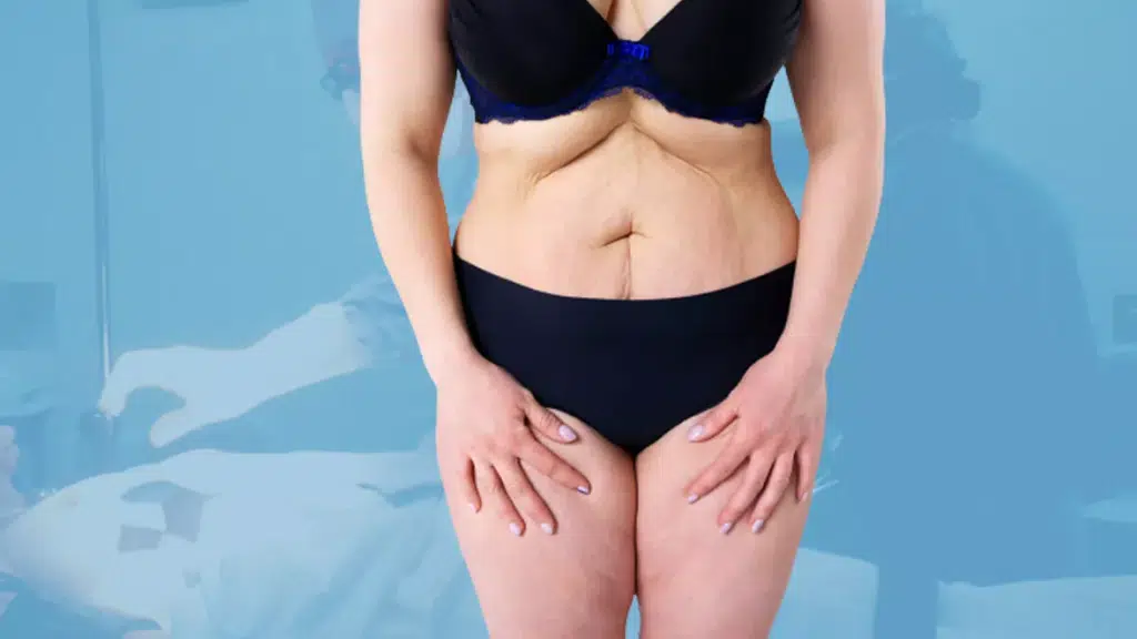 Best Liposuction Delhi