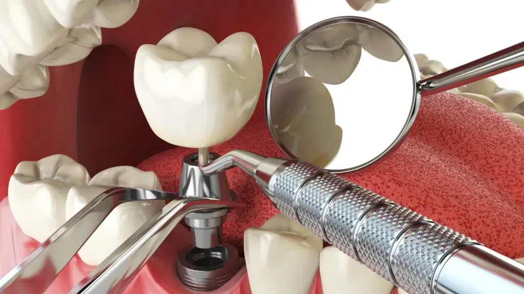 Dr Gourav Ahuja's Elite dental Implant Centre