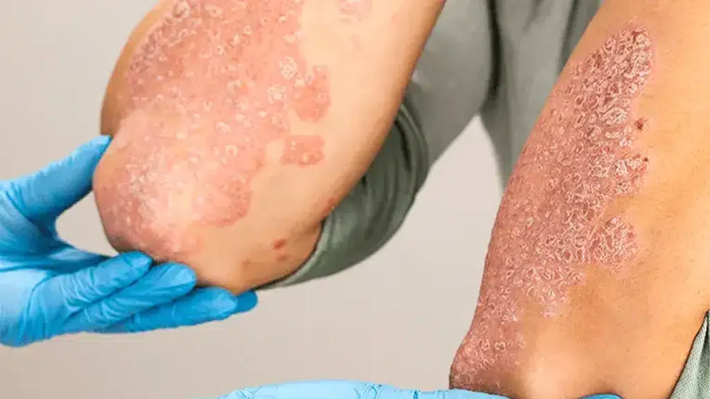 Sri  Bhaskara Psoriasis Hospital 