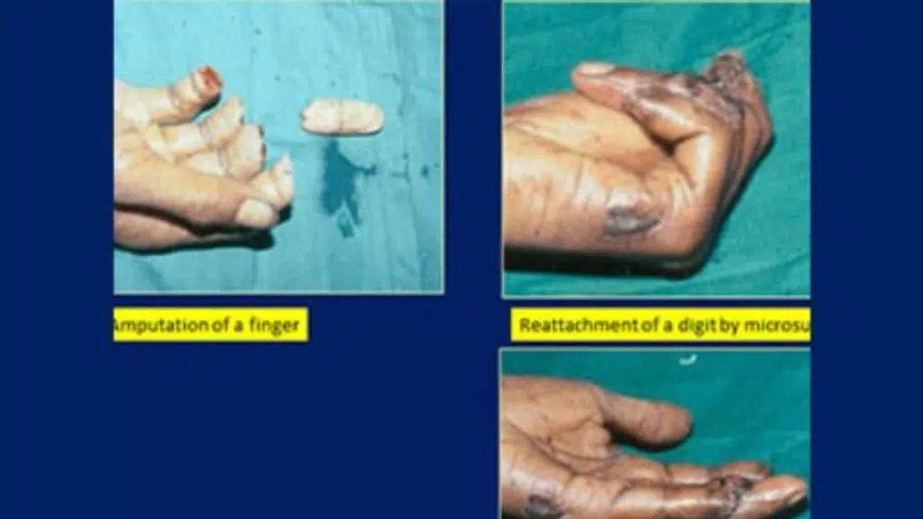 Dr Pankaj Jindal-Hand surgeon
