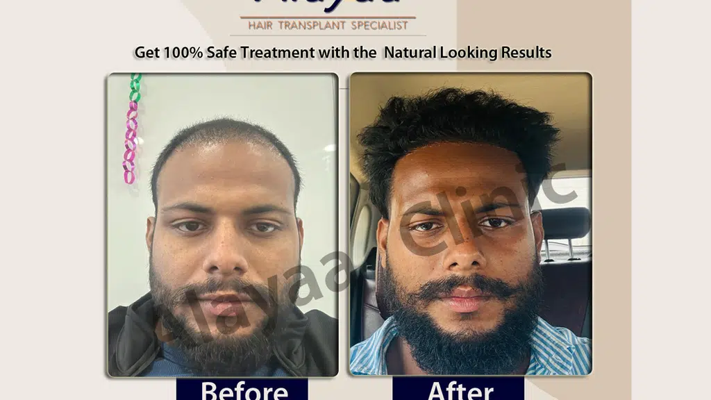 Alayaa Hair Transplant Clinic
