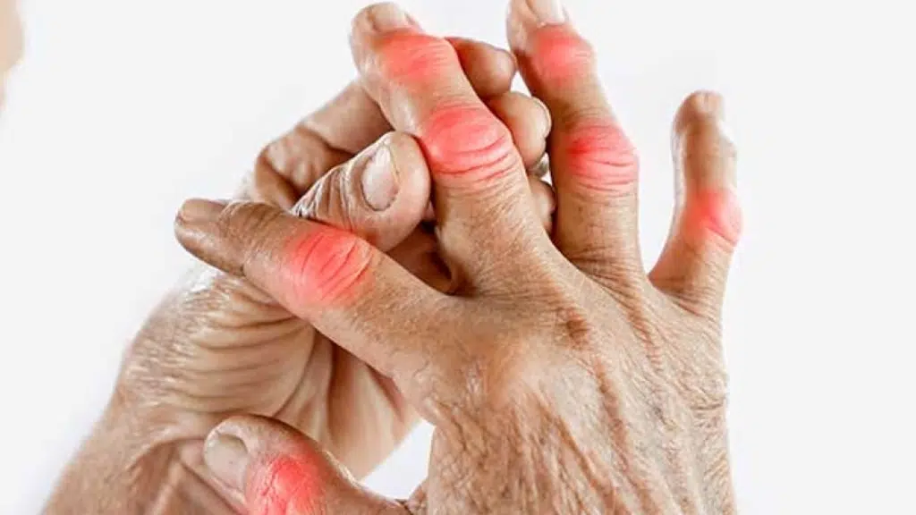 Apex Center for Rheumatology