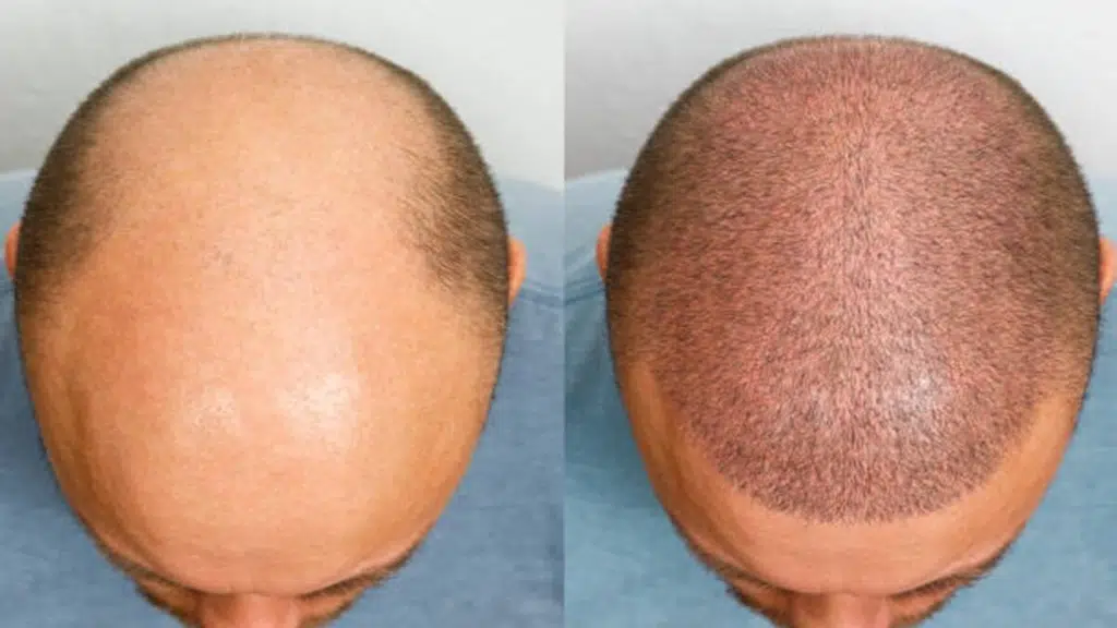 Shine Hair Transplant