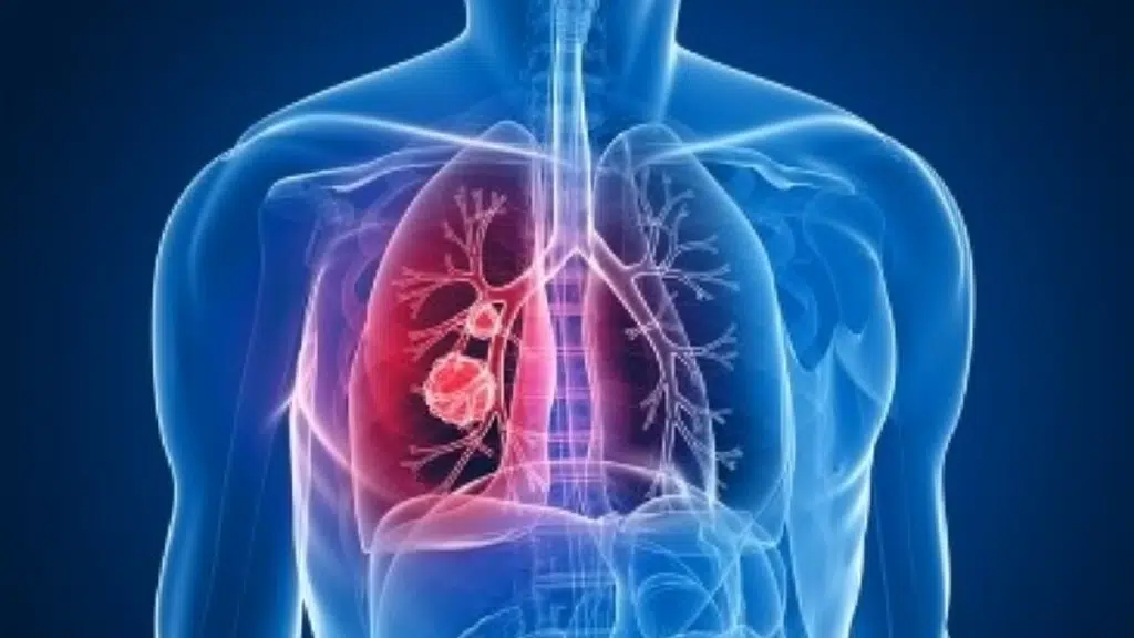 Dr Darlong's Lung Cancer Clinic, Delhi