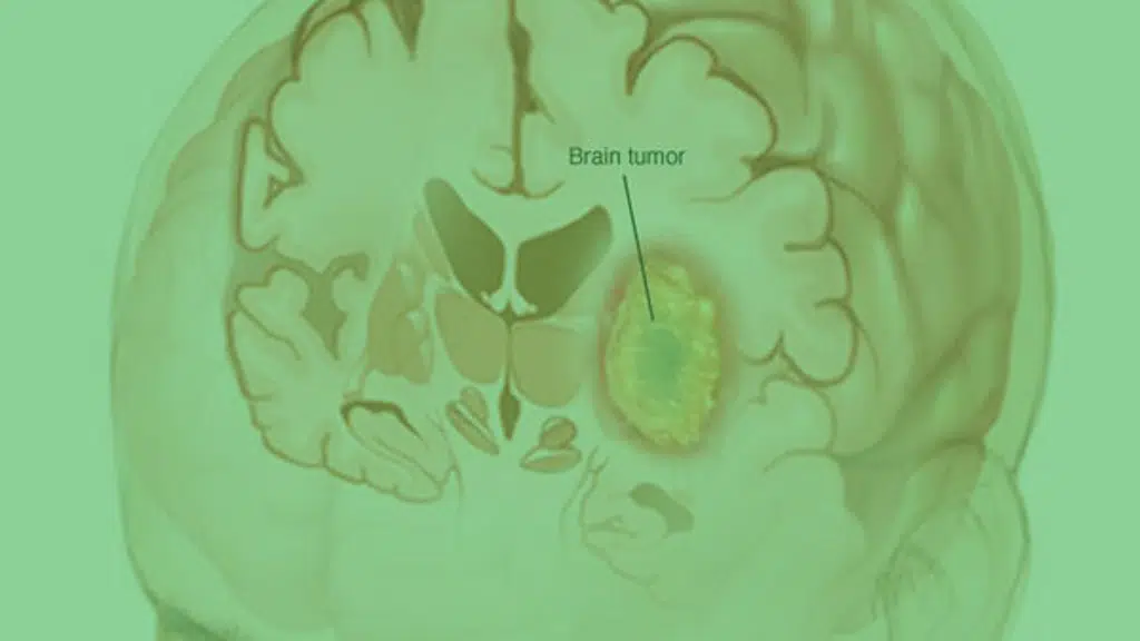 QUALILIFE BRAIN AND SPINE-Dr Viswanathan Iyer