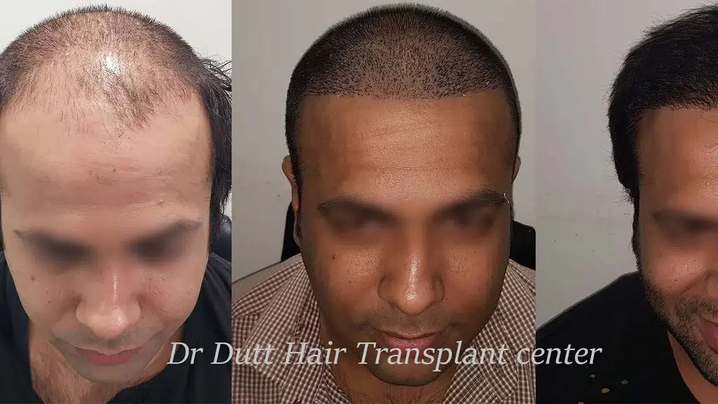 Dr Dutt Hair Transplant
