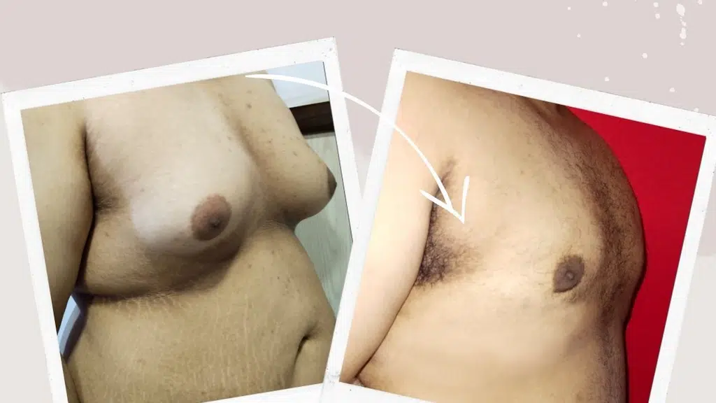 Dr. Ashish Khare Plastic Surgeon & Gynecomastia Surgeon