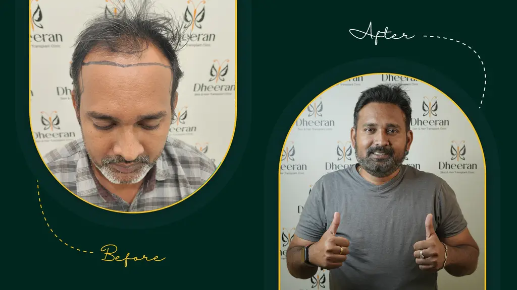 Dheeran Hair Transplantation Clinic