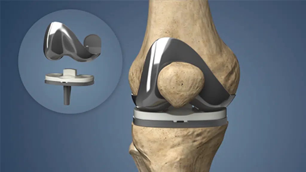 Dr Jagdish Pusa | Best Orthopedic Surgeon  | Knee, Hip and Joint Replacement surgeon