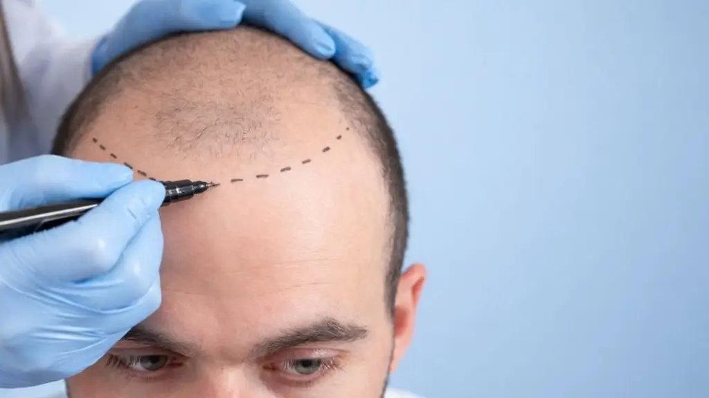 unique hair transplantation and prp clinic thodupuzha