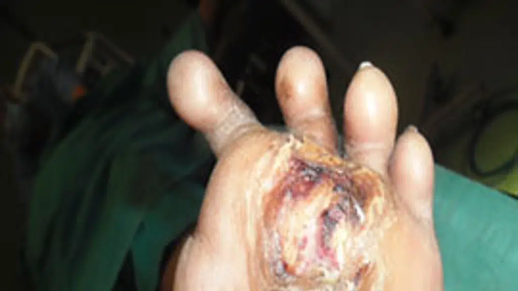 Dr. Aadarsh Kabra - Vascular Surgeon  | Varicose Veins | Diabetic Foot | DVT