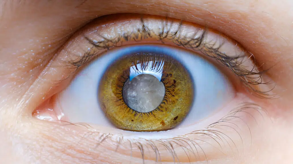 Eye Care Secunderabad | Cataract & Retina Surgeon | Eye Hospital