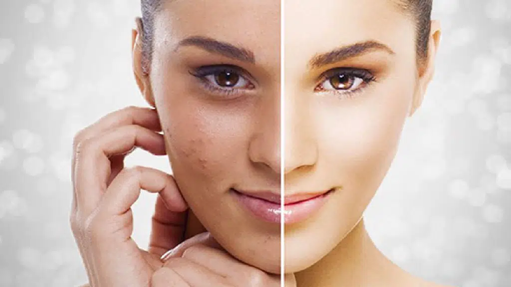 Kare For You - A perfect Laser Beauty Solution